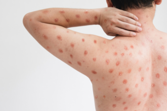 Mpox no Paraná: primeiro caso de 2026 reacende alerta sanitário e reforça importância da vigilância em saúde